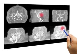 Aneurisma cerebral